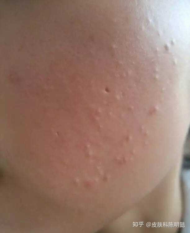 脸上白色小颗粒