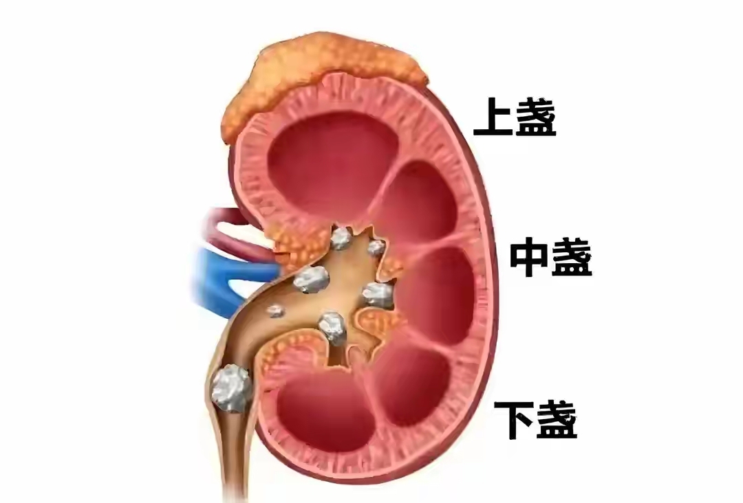 人为什么会得肾结石呢?
