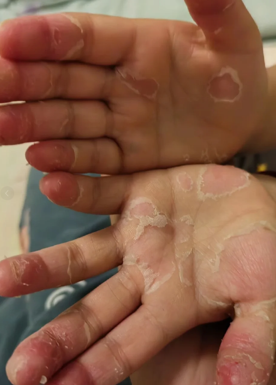 小孩手脚脱皮怎么回事