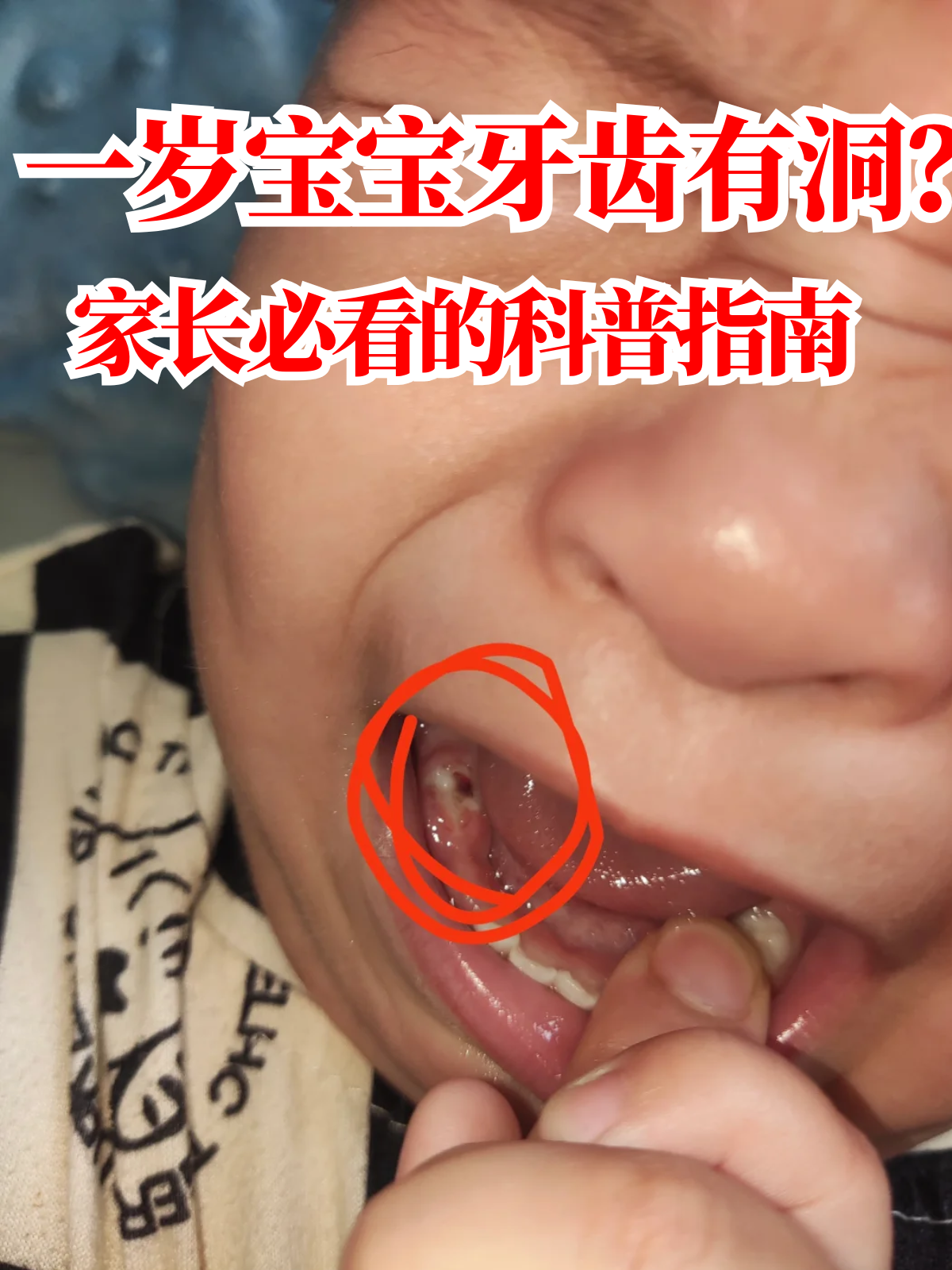 牙齿有洞怎么办