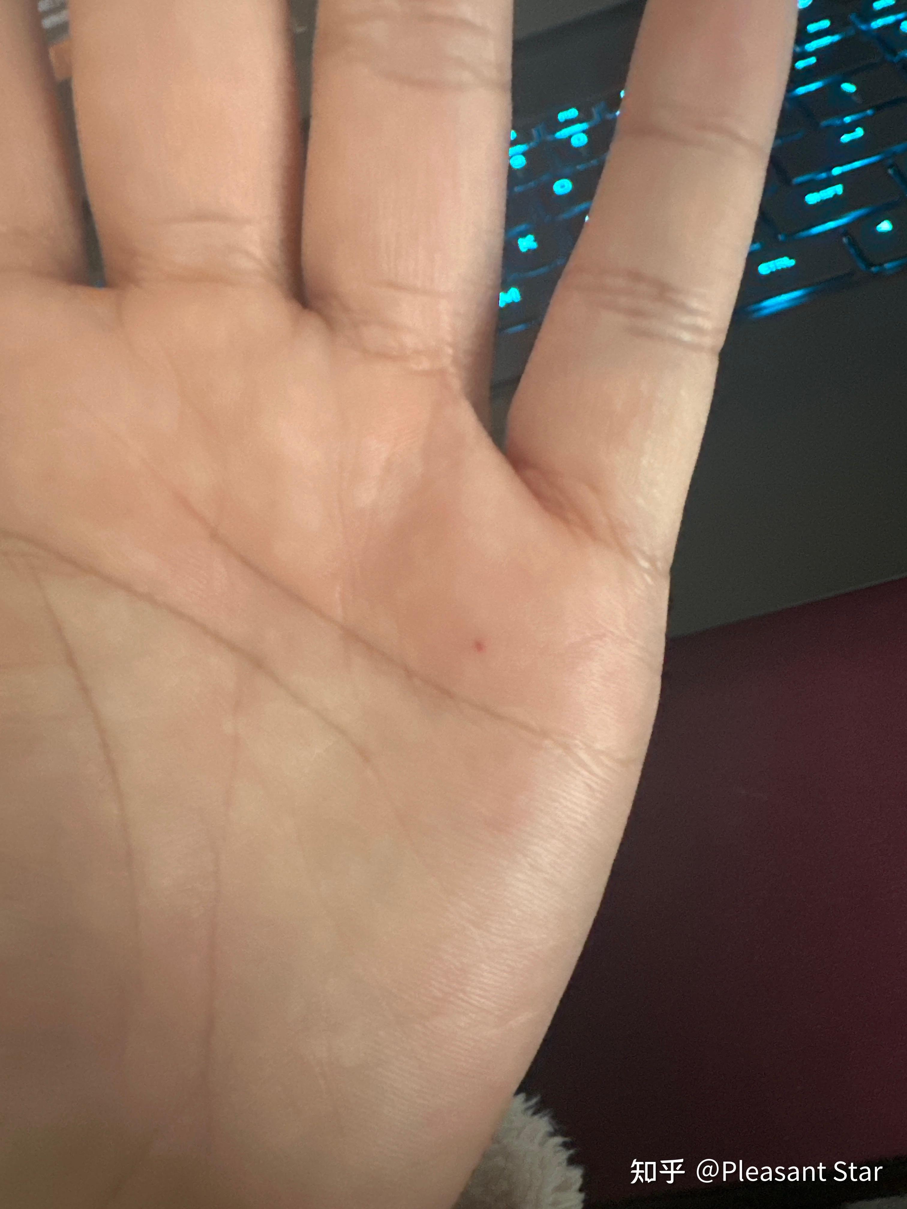 手上起红点怎么回事.