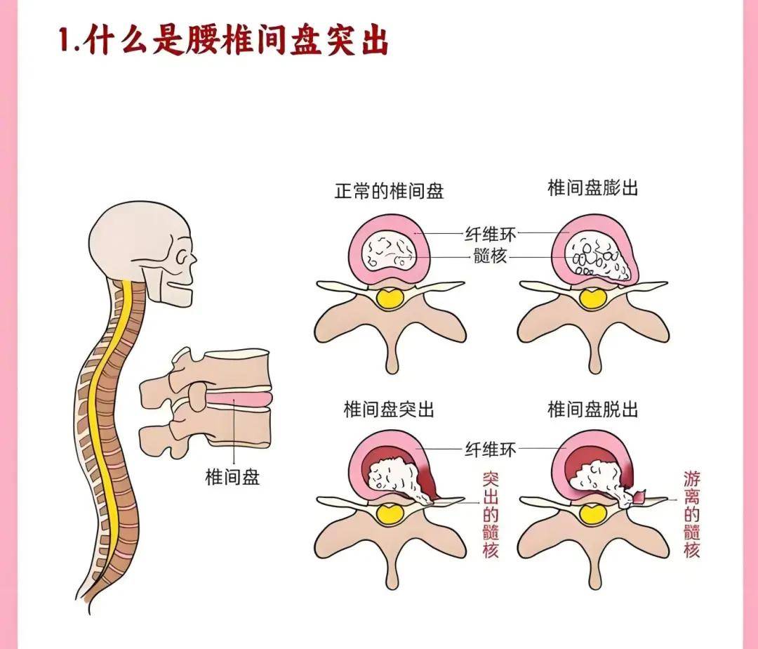 腰椎间盘突出症的初期症状是什么