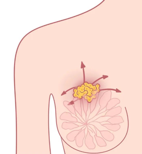 乳腺纤维瘤会痛吗