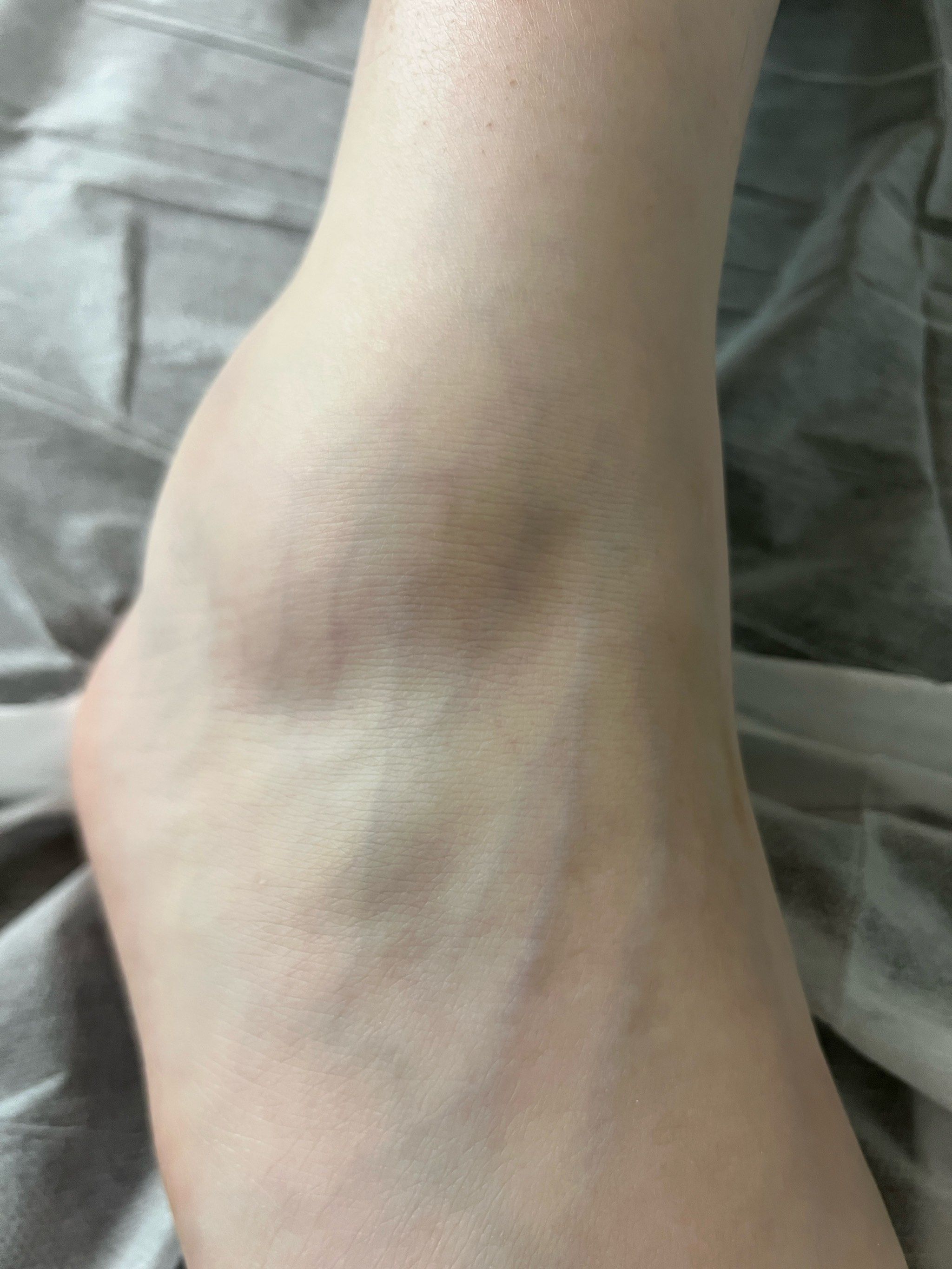 脚腕肿了怎样可以快速消肿