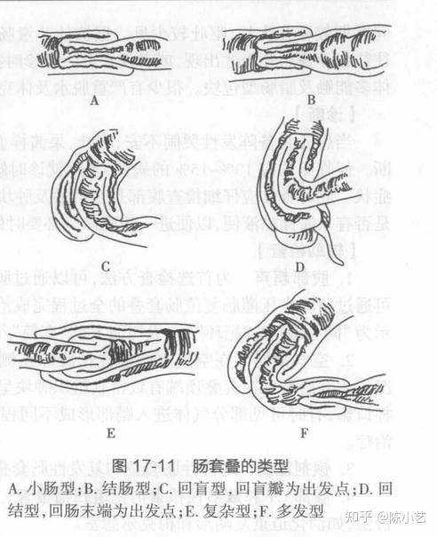 肠套叠主要临床表现