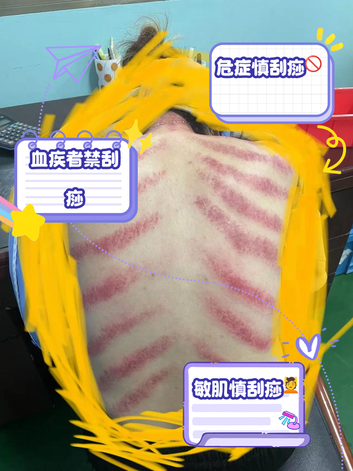 刮痧之后不能同房吗?