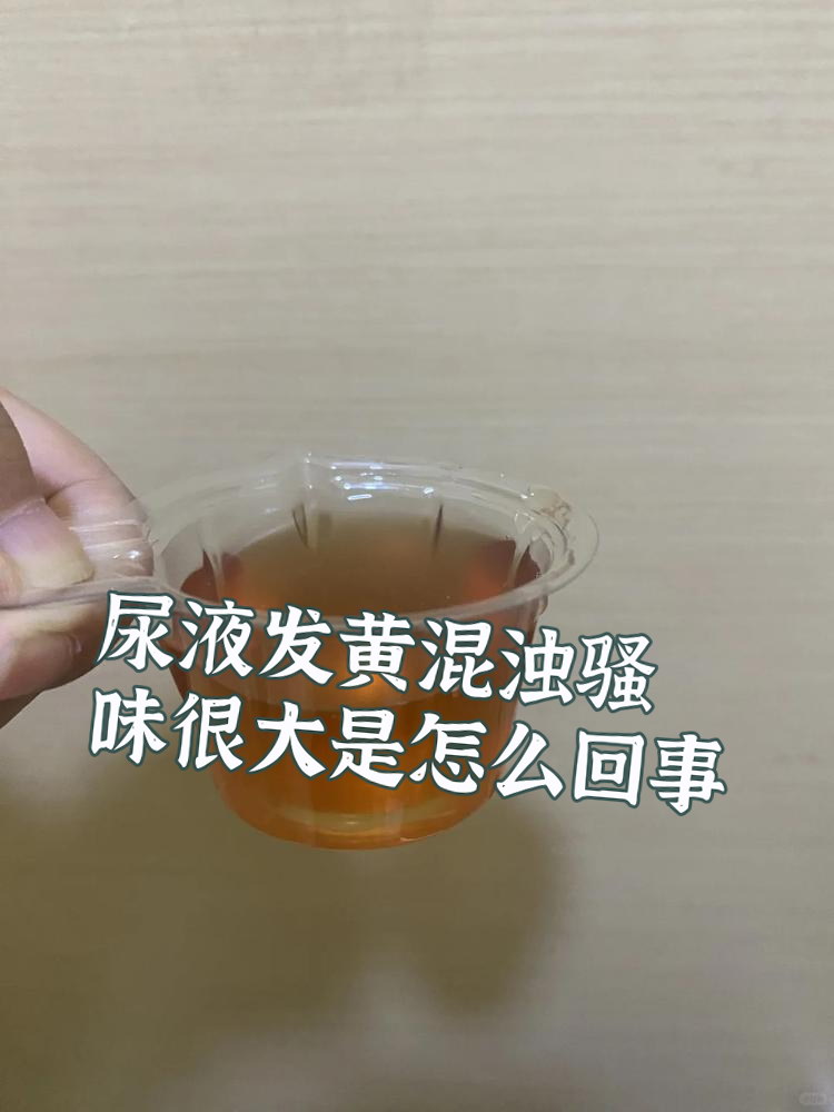 尿液发黄有泡沫?