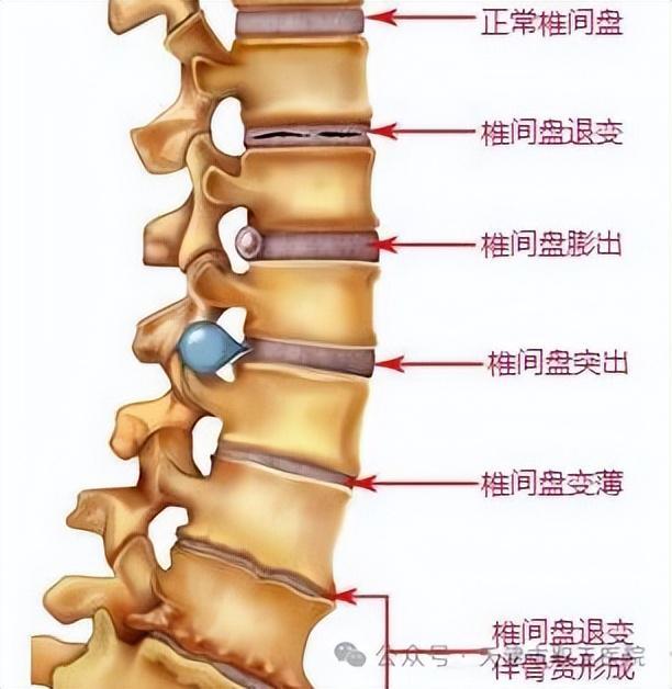 什么是腰椎椎管狭窄症?