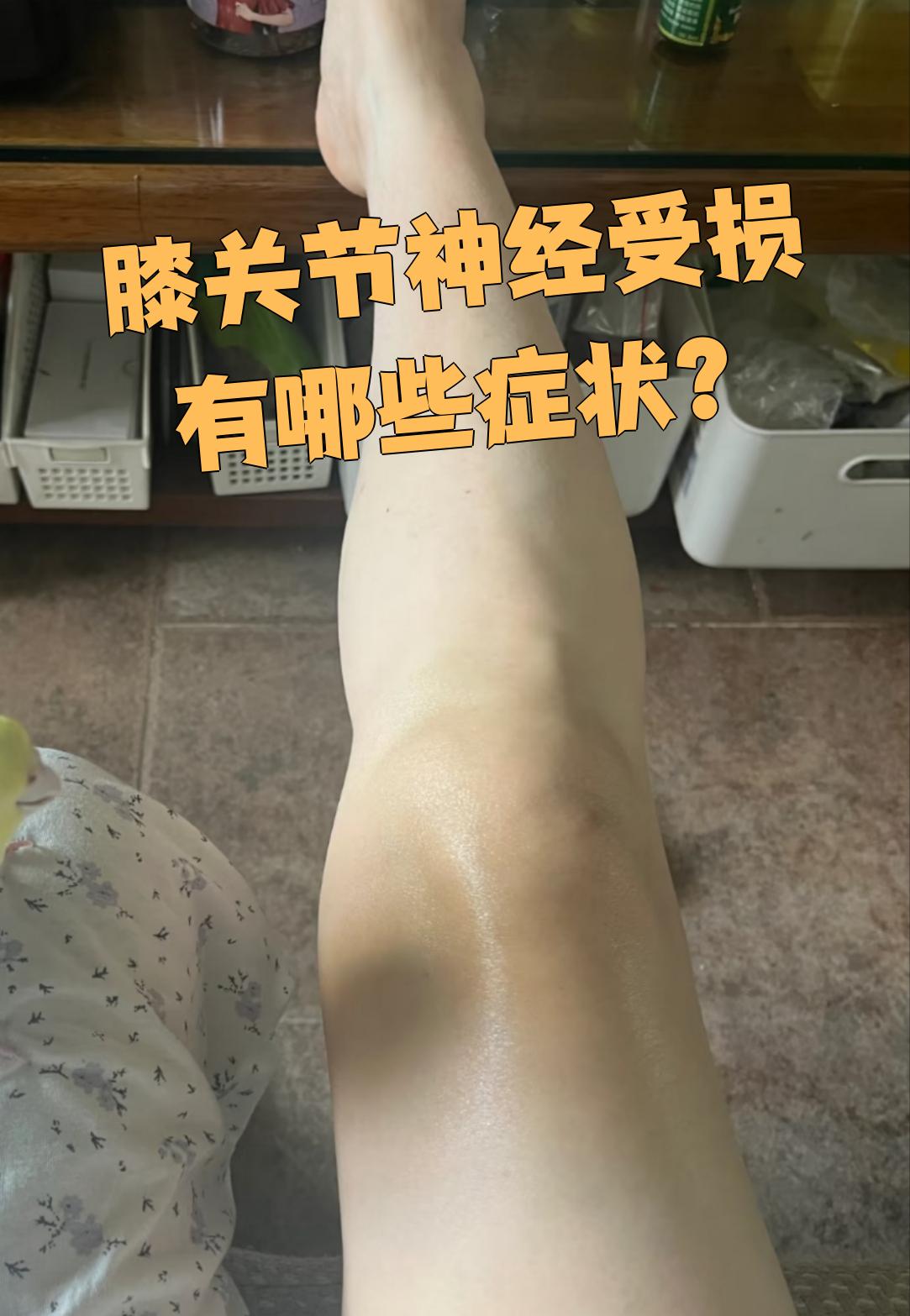 膝盖的筋扭到了,疼了好几天