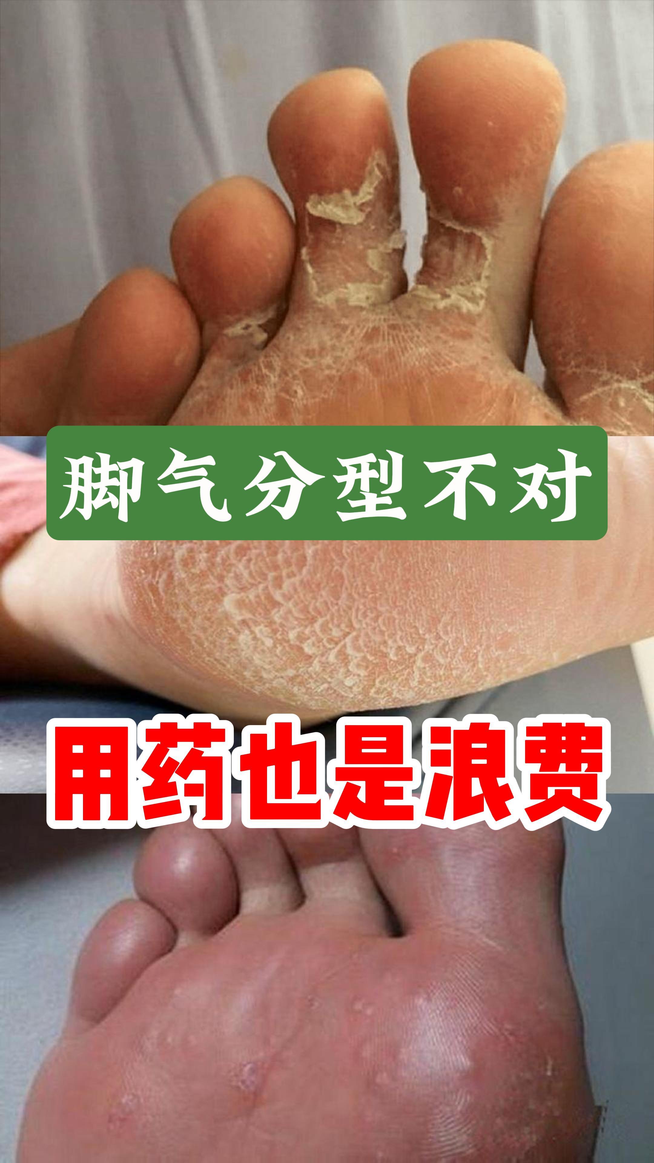 孕妇有脚气怎么治疗