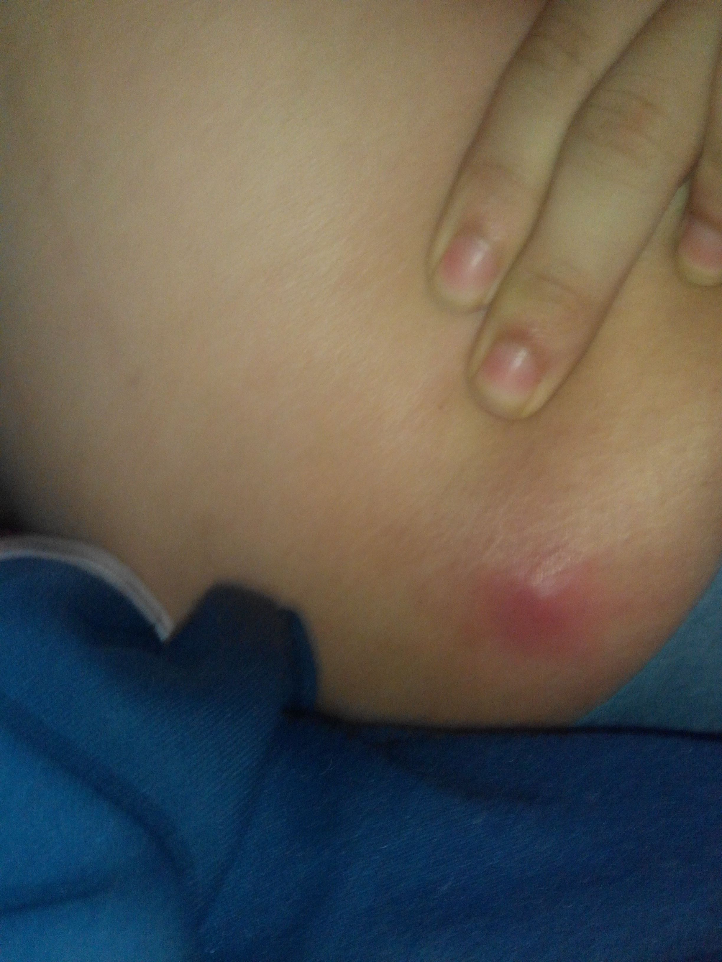 屁股上长了一个包很痛是怎么回事