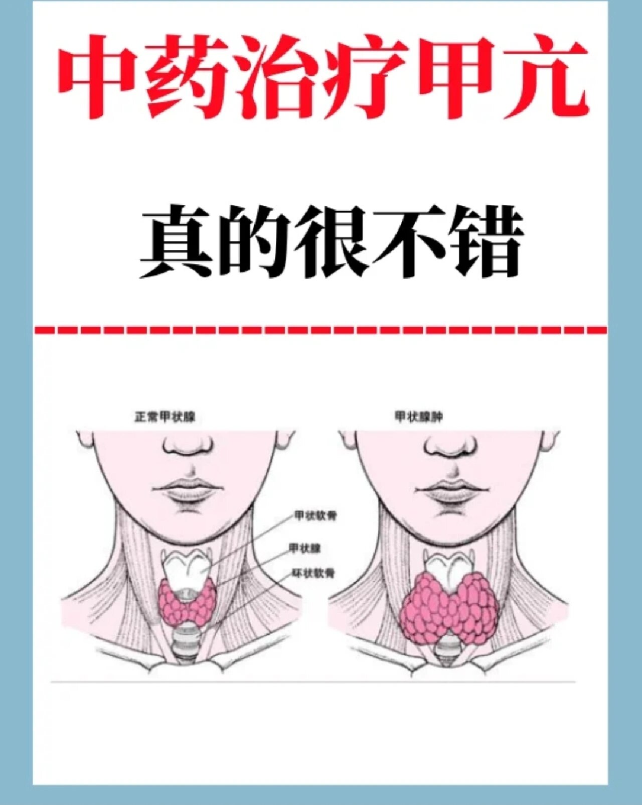 甲亢的几种治疗方法