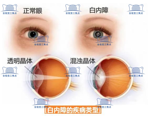 白内障的早期症状有哪些?