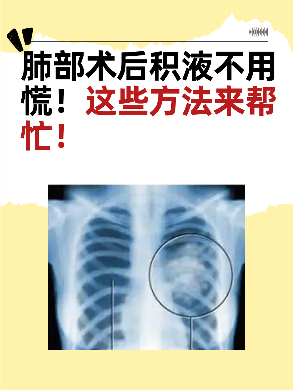 肺部有积液是怎么回事,怎么治疗
