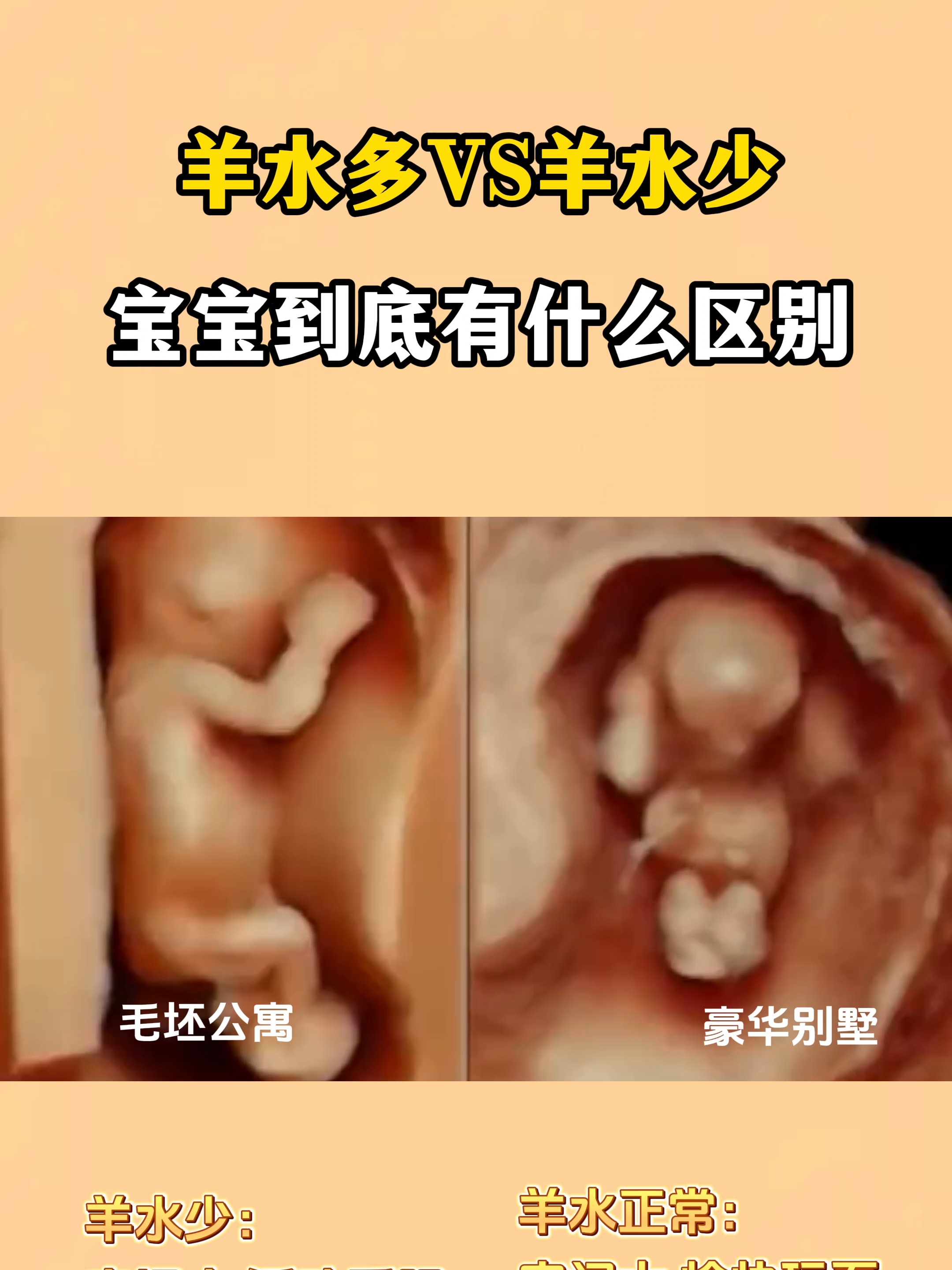 什么叫羊水过少?