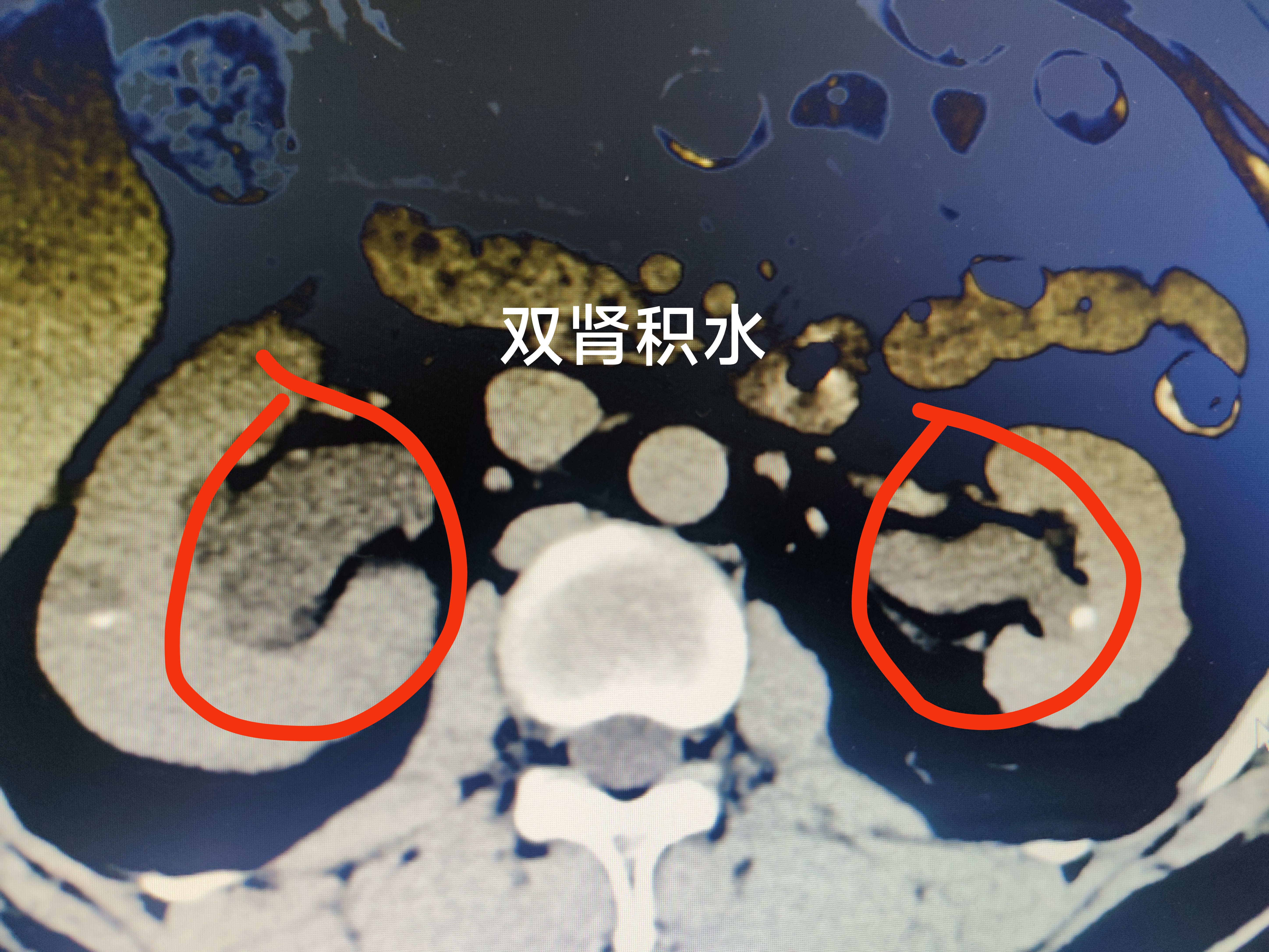 正常肾脏超声图像是怎样的
