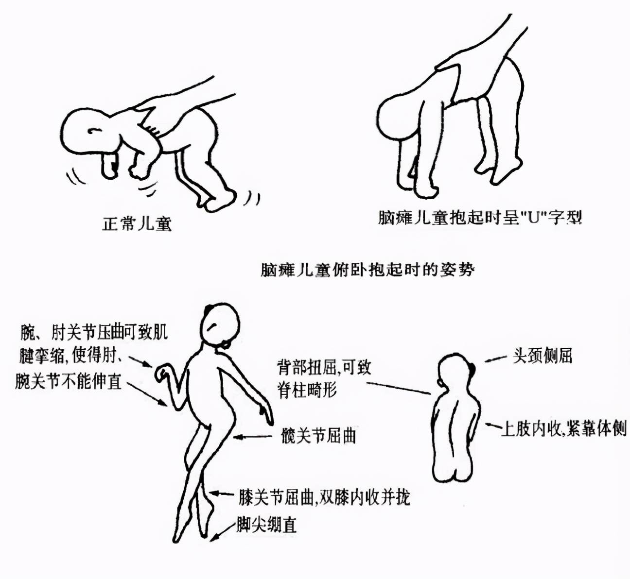 婴儿脑瘫症状有哪些表现