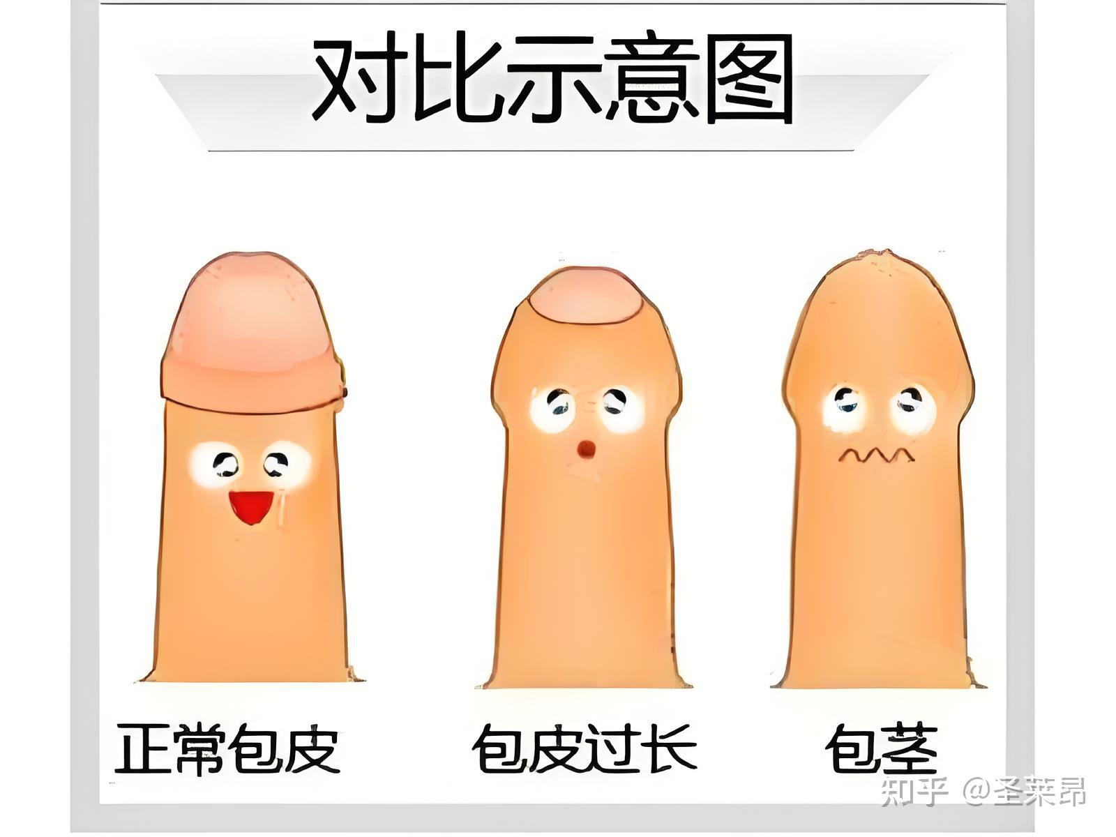 包皮,到底要不要割?