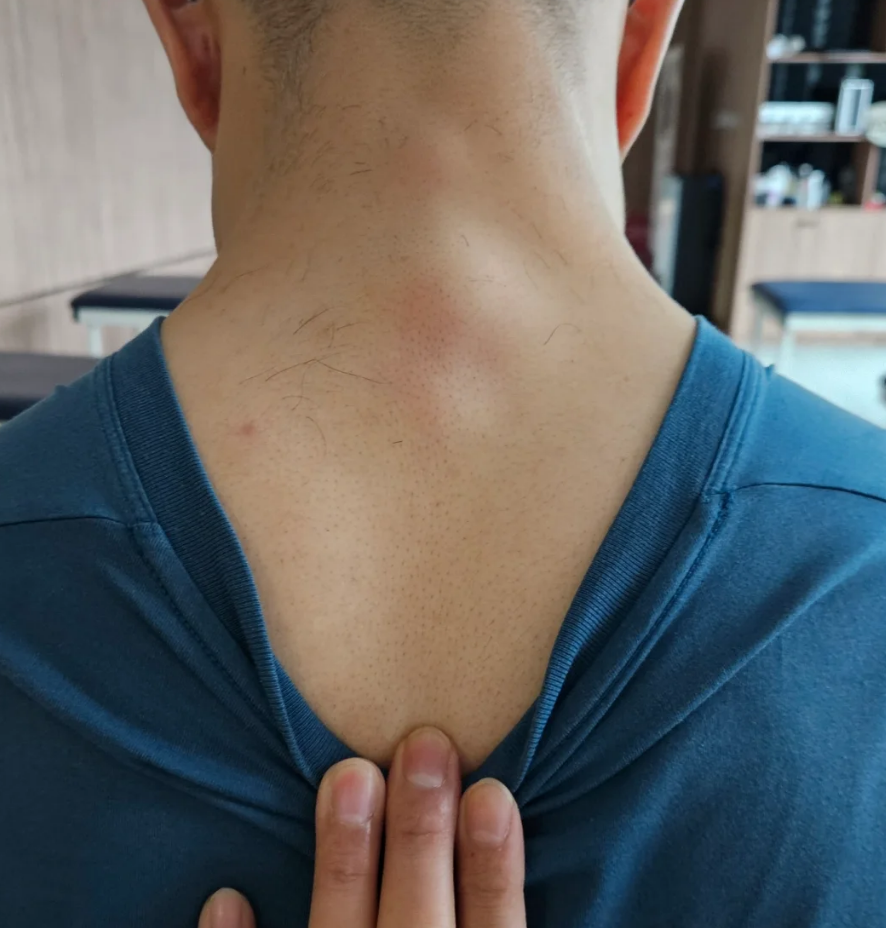 脖子后面疼是颈椎病吗?