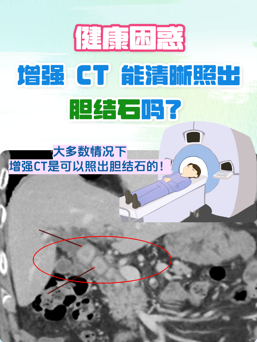 增强ct怎么做