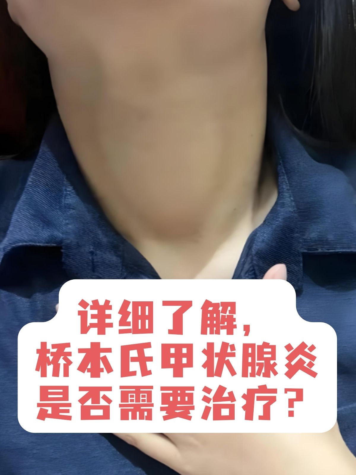 桥本氏甲状腺炎是什么病?