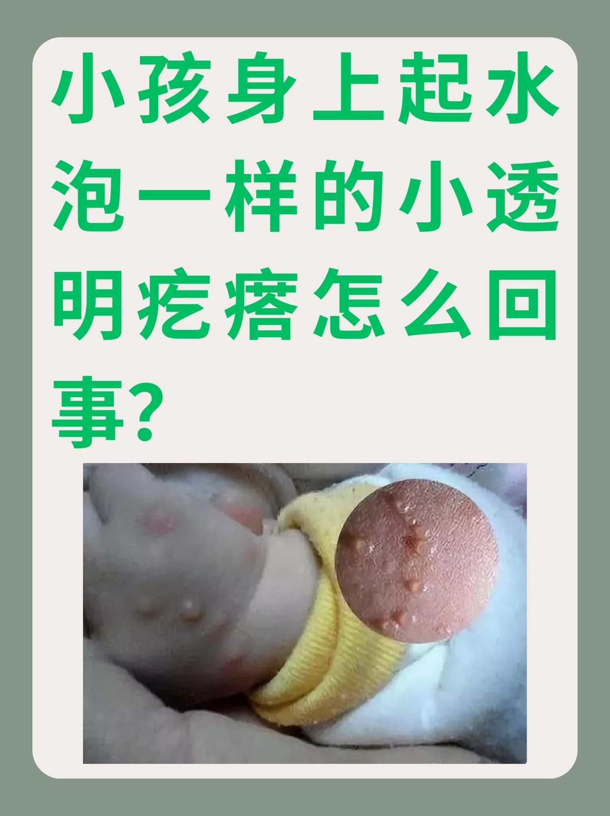 孩子身上起大片扁疙瘩是怎么回事?