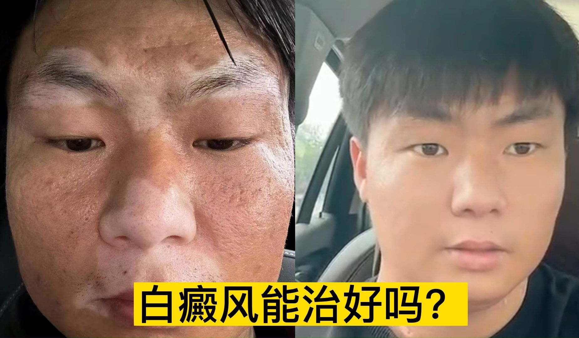 我朋友身上的白癜风治好了
