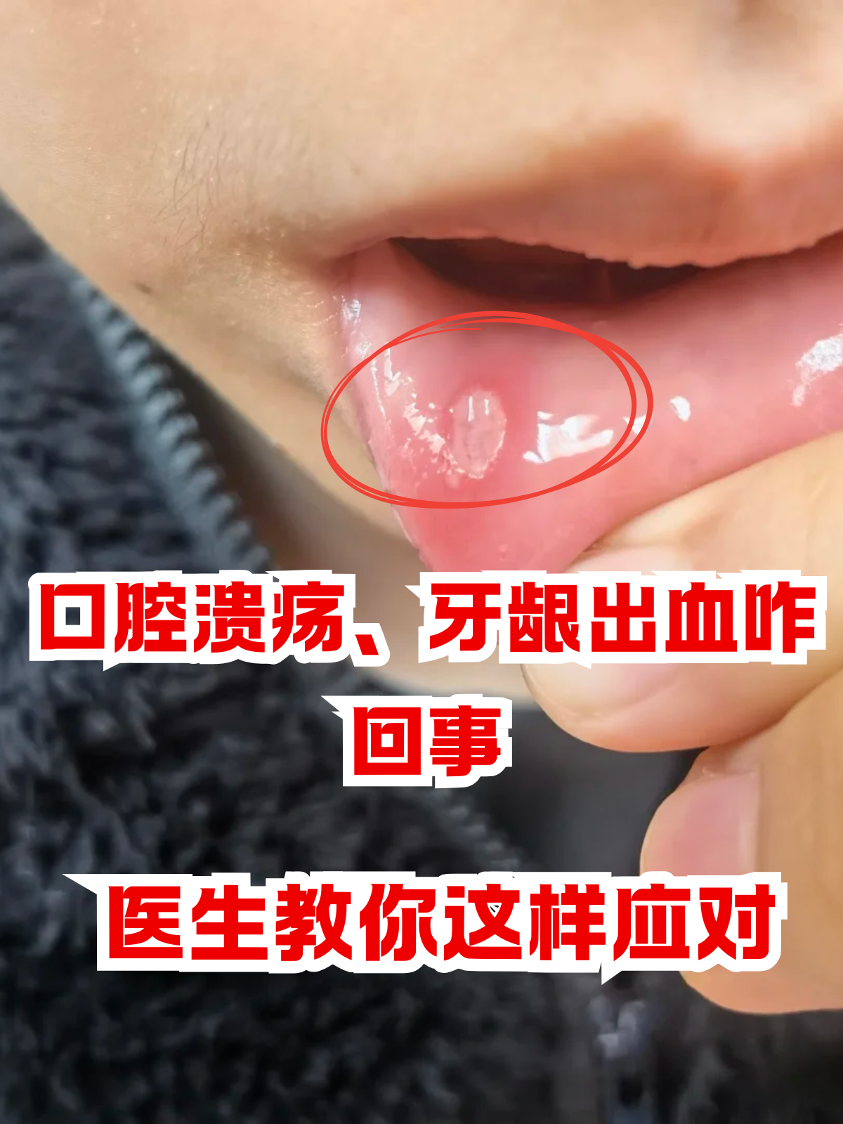牙龈出血的疾病征兆