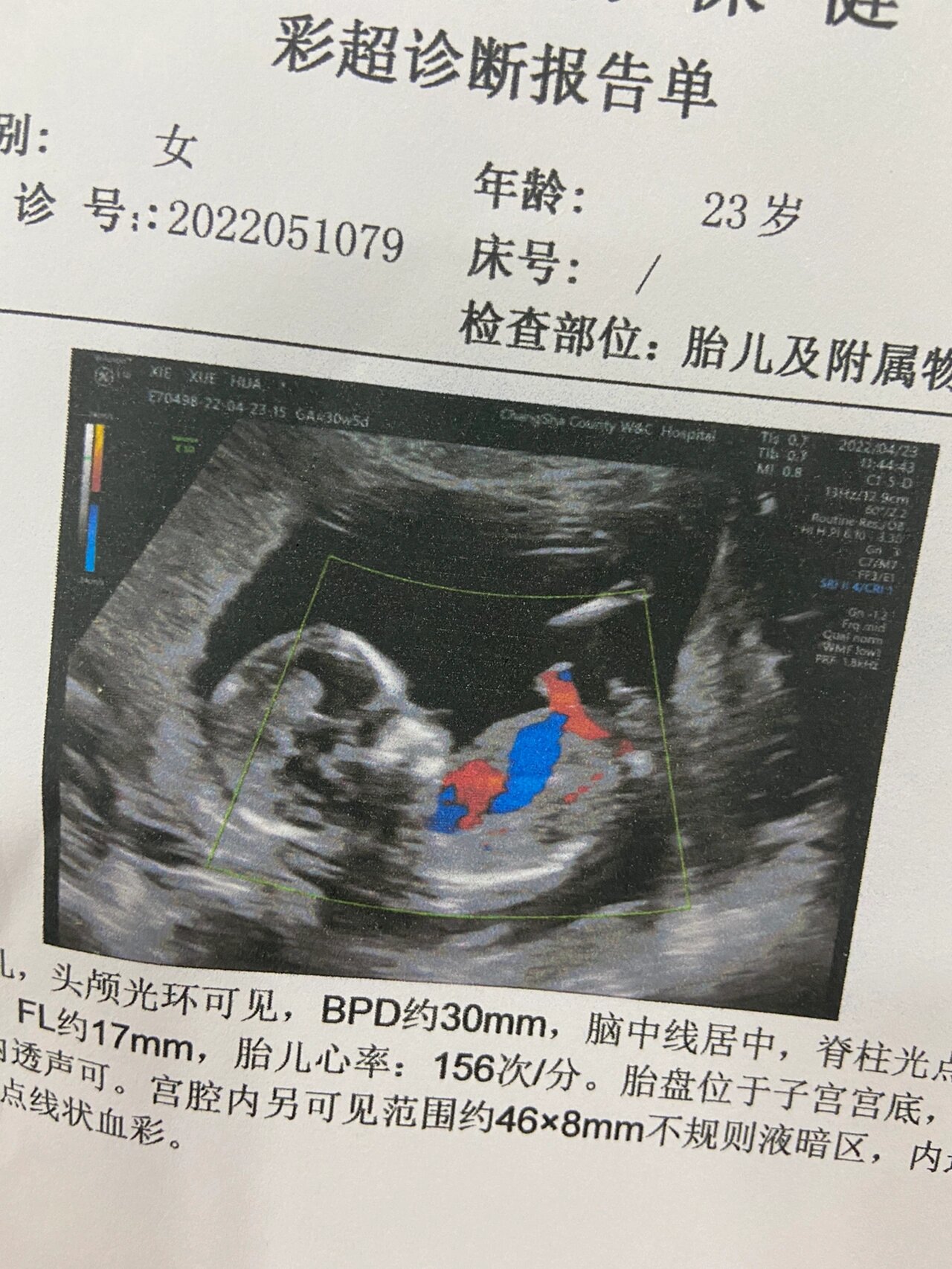怀孕有宫腔积液严重吗