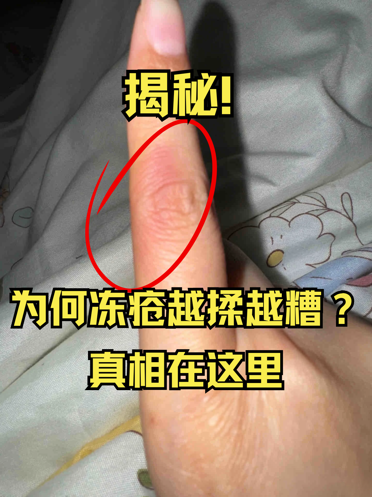 手冻疮的治疗方法有哪些呢