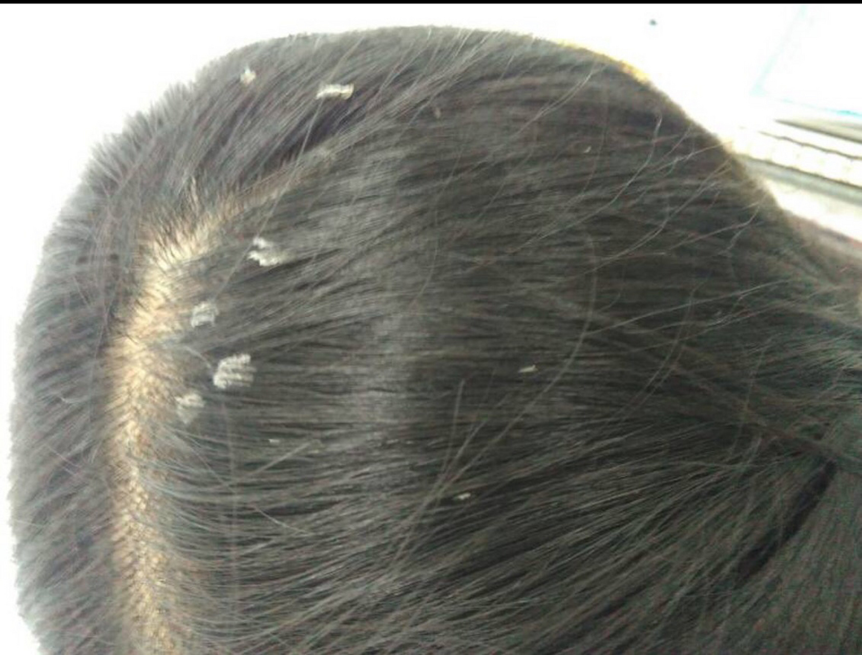 什么叫脂溢性皮炎