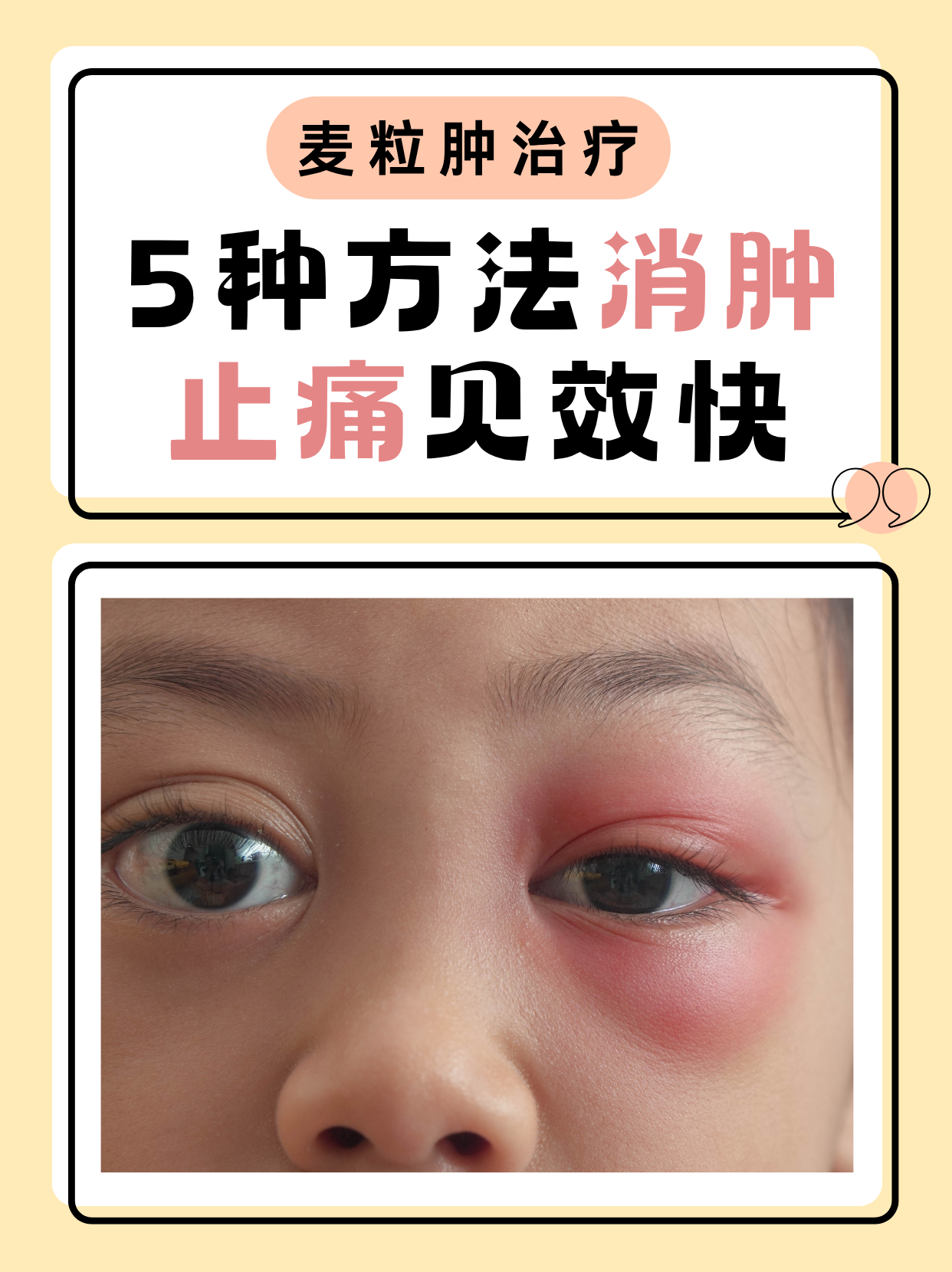 针眼怎么治疗