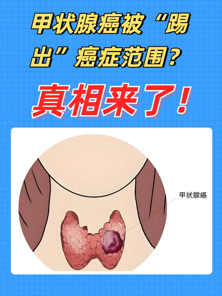 甲状腺瘤的症状