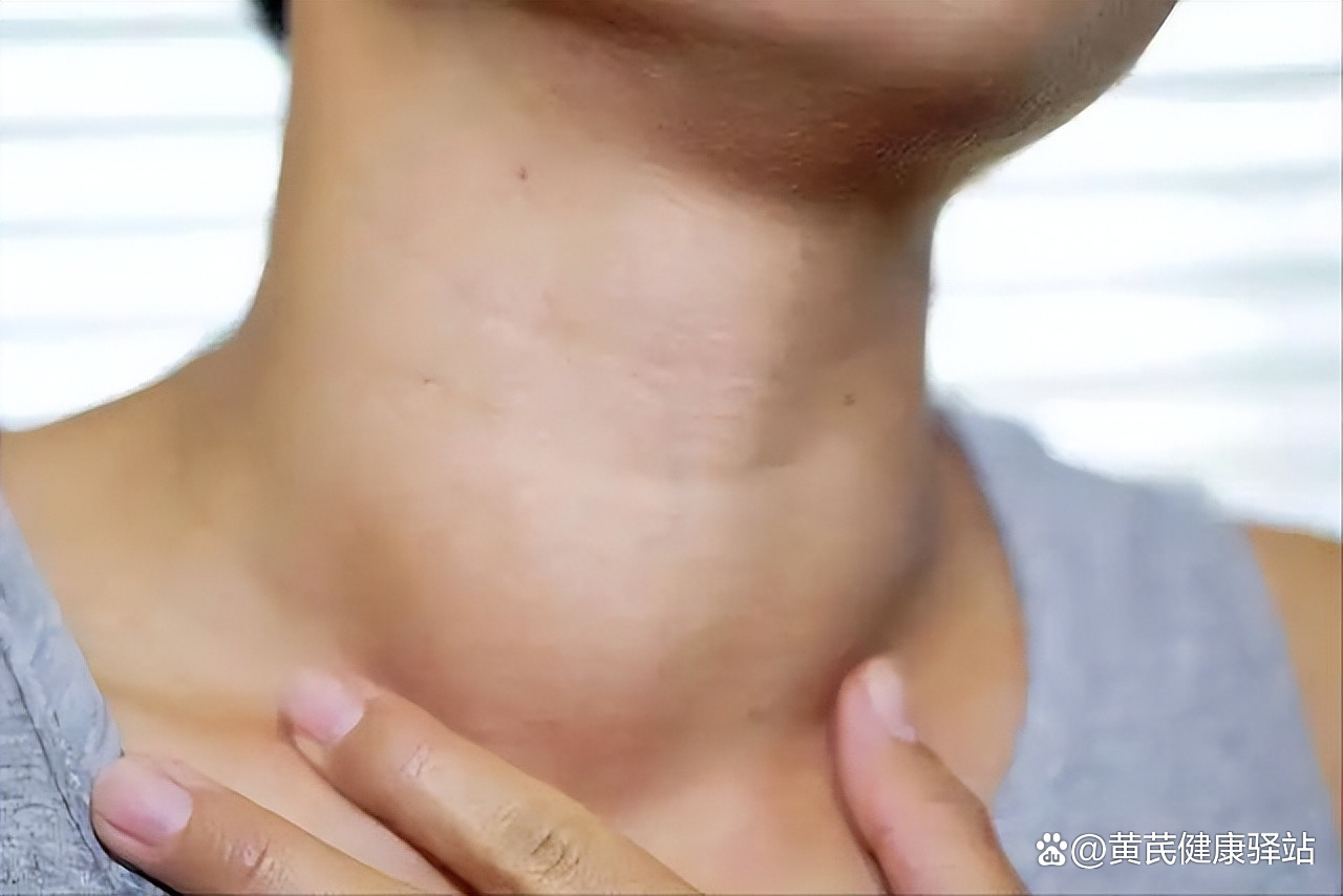 甲状腺瘤的症状