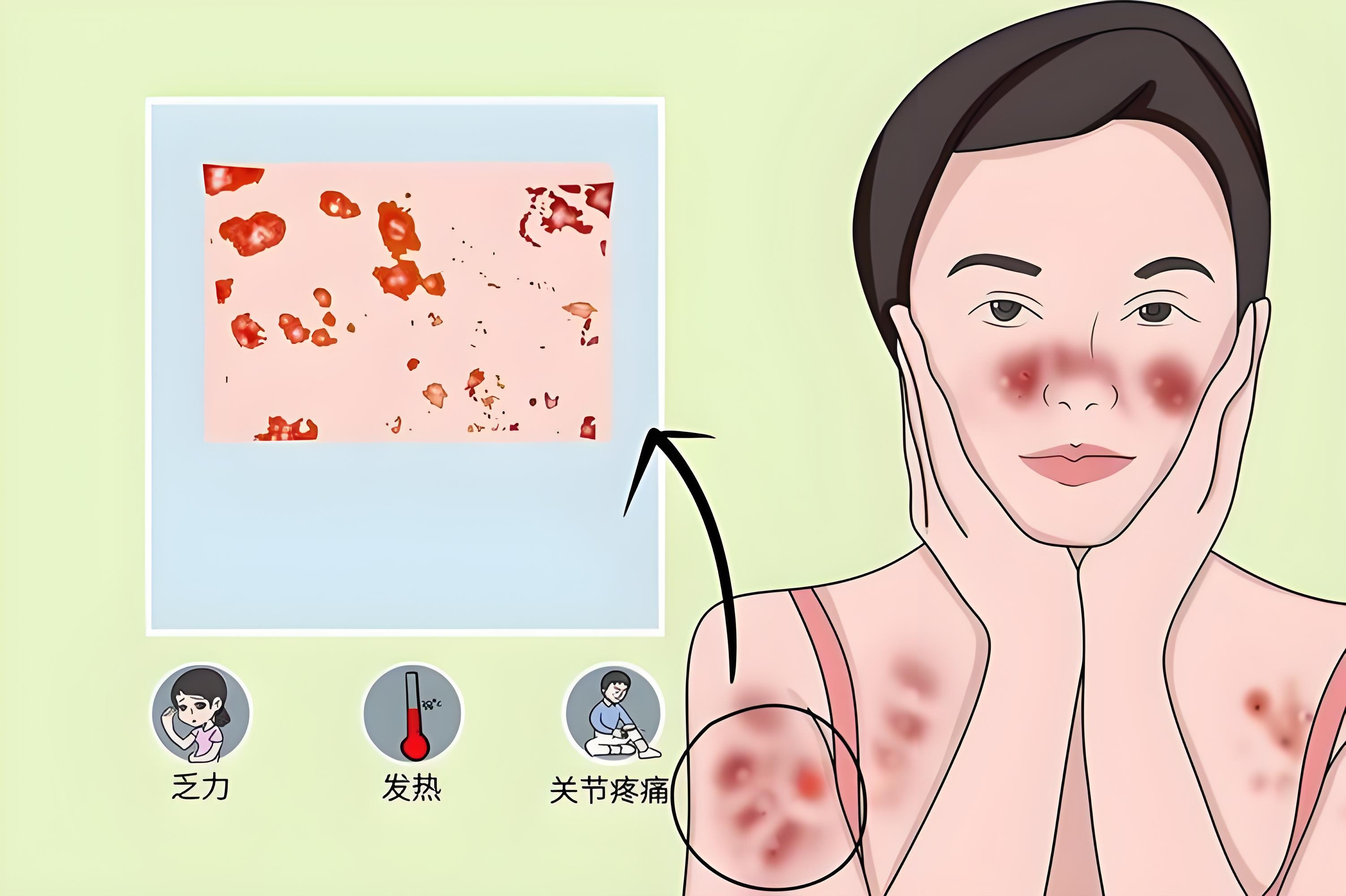 狼疮肾炎是肾病吗