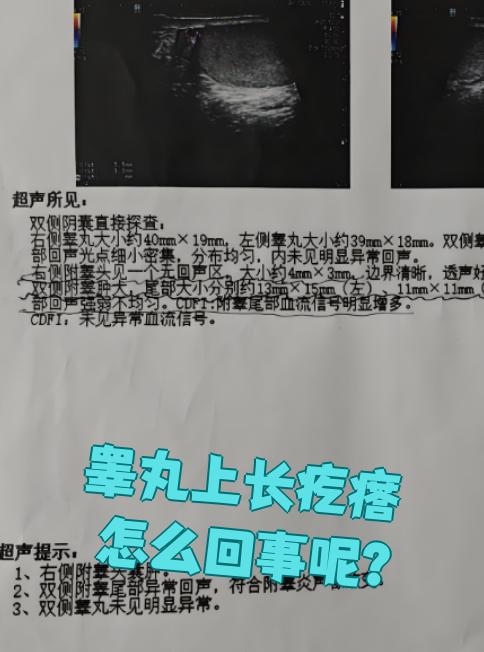精囊肿怎么回事