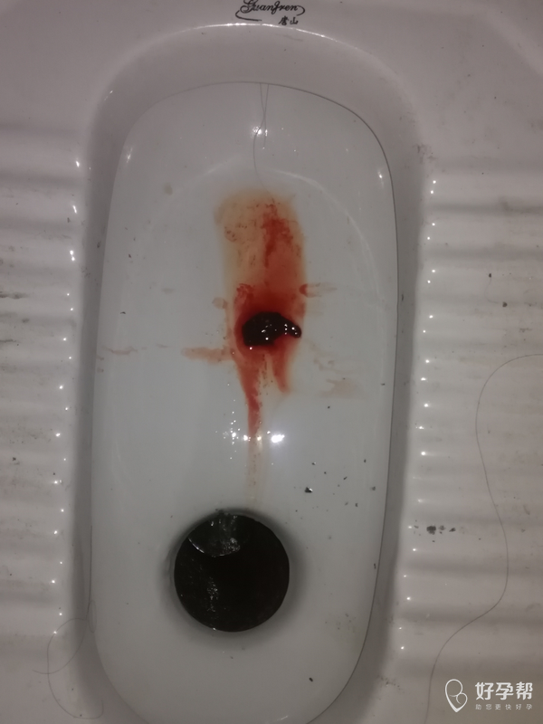 流产后来月经量多鲜红