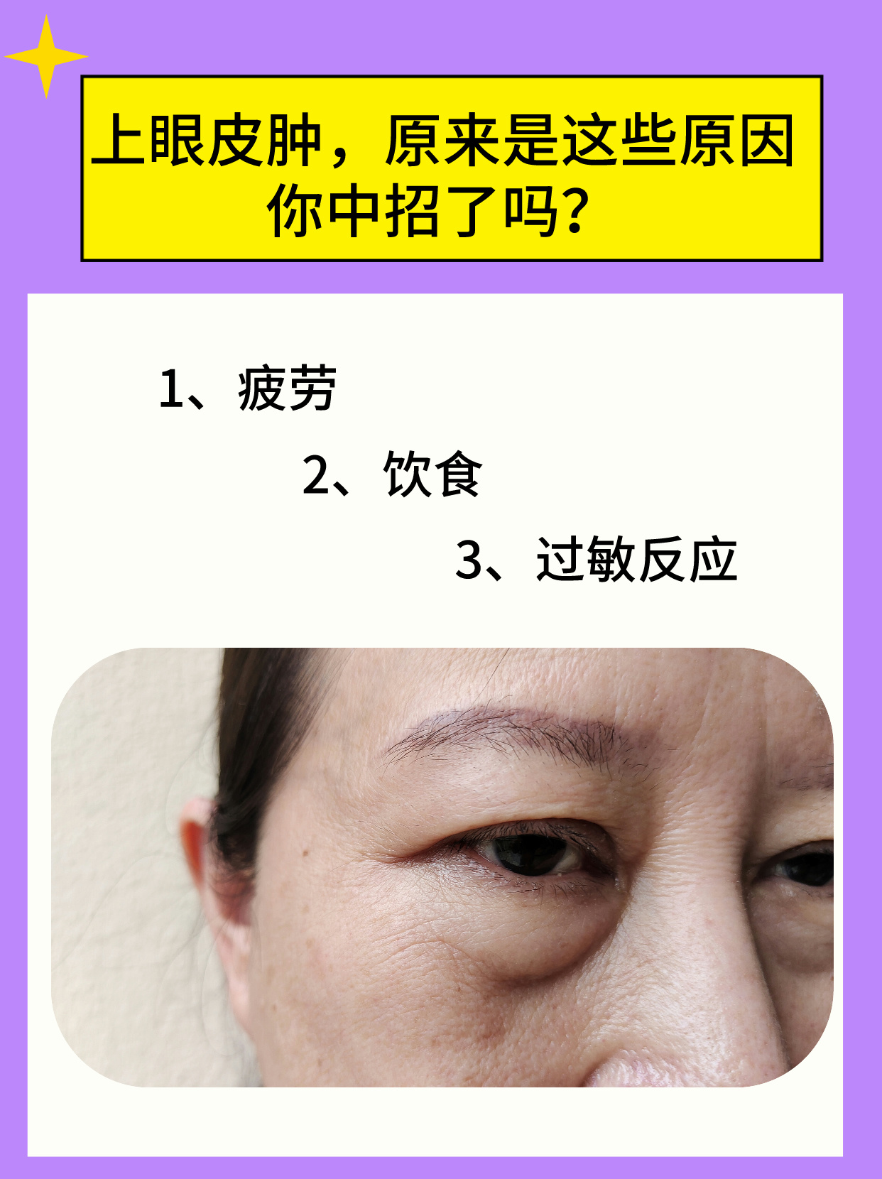 上眼皮又痒又肿怎么办