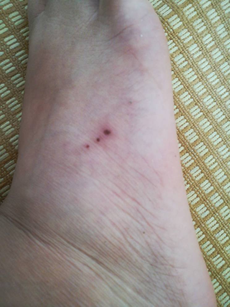 被老鼠咬到潜伏期多久?