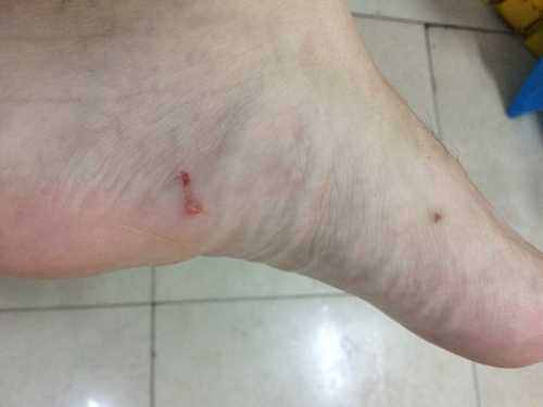 被老鼠咬到潜伏期多久?