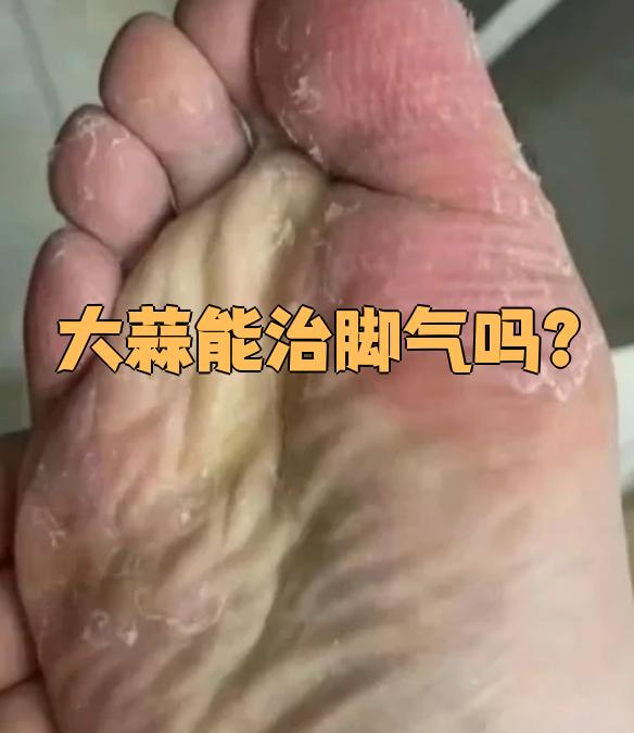 脚气的症状是什么?