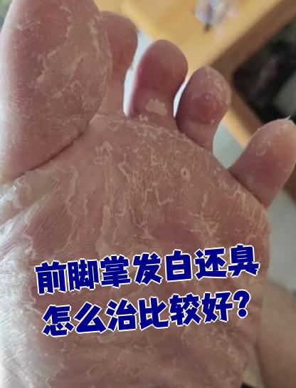 脚气的症状是什么?