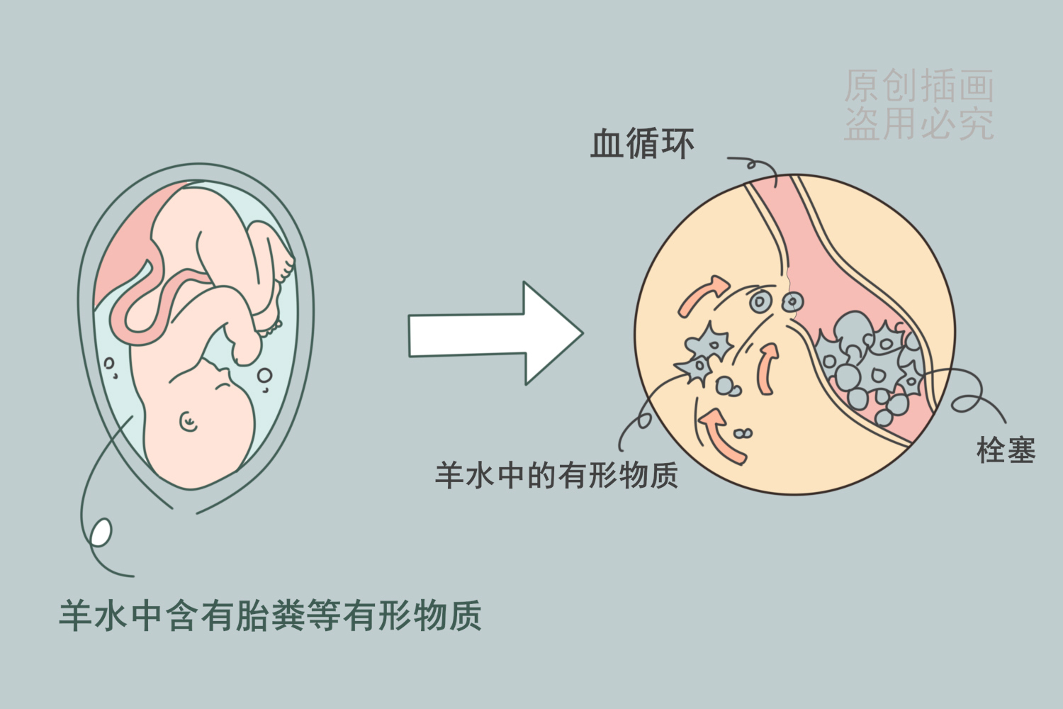 羊水栓塞可以完全预防吗?