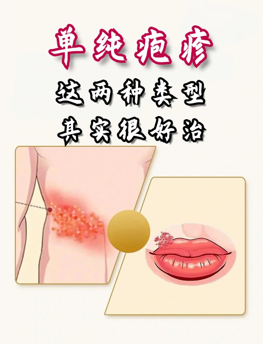 单纯疱疹如何彻底治疗