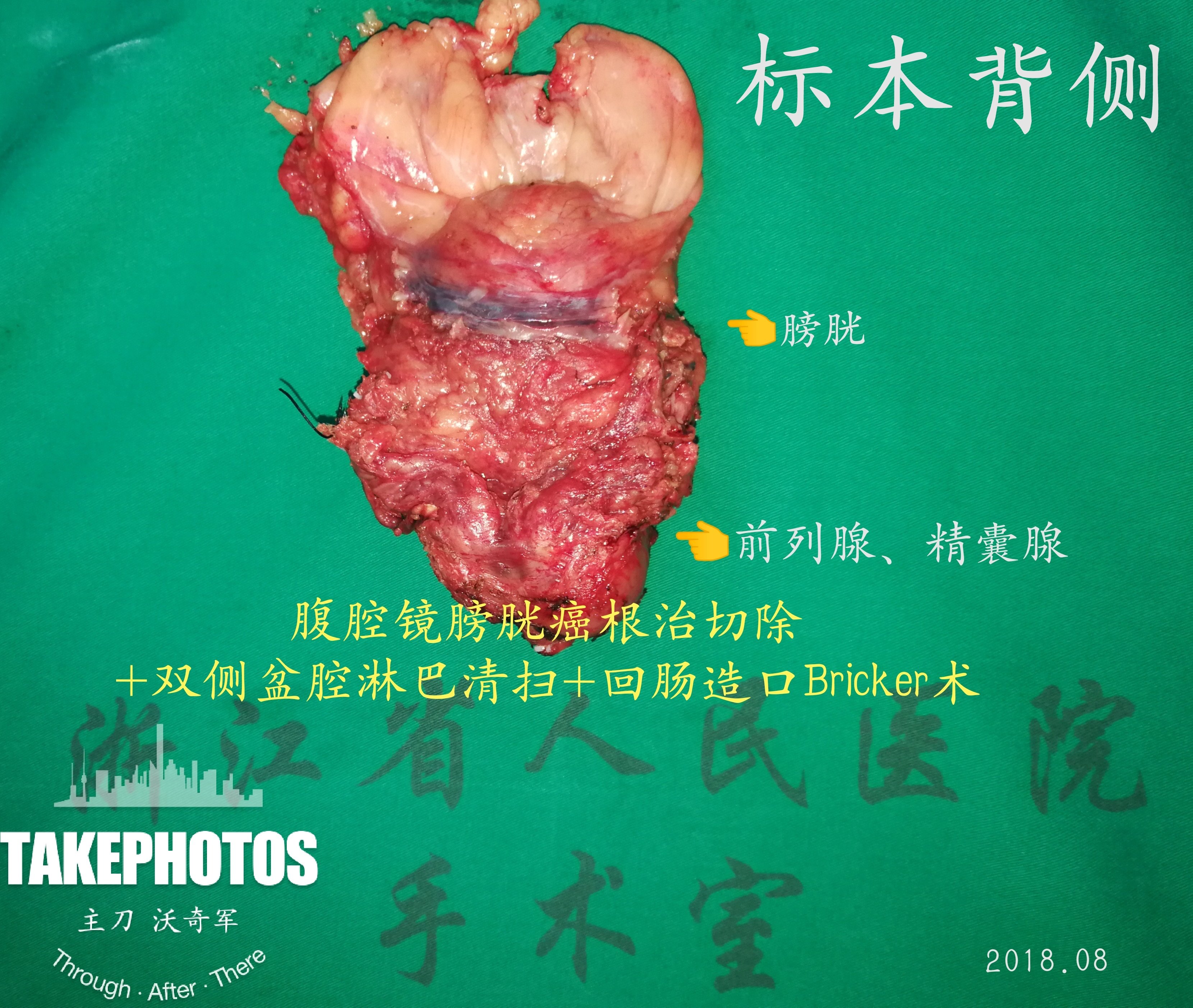 膀胱癌手术后还能活多久