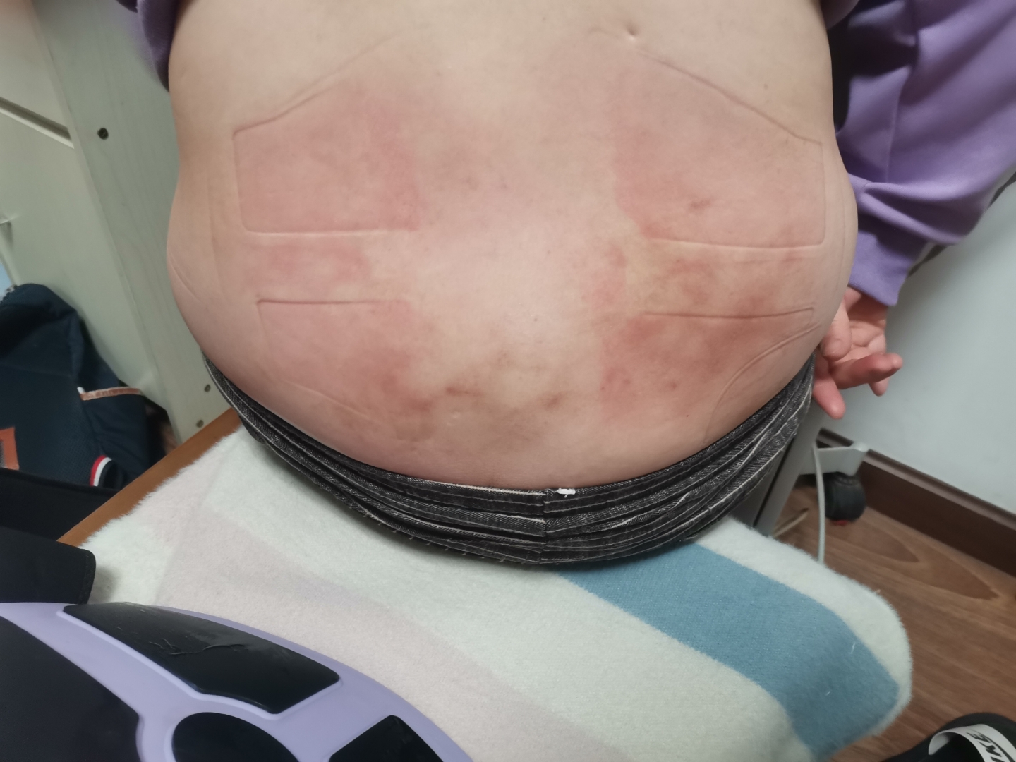 腰麻术后的后遗症有哪些?