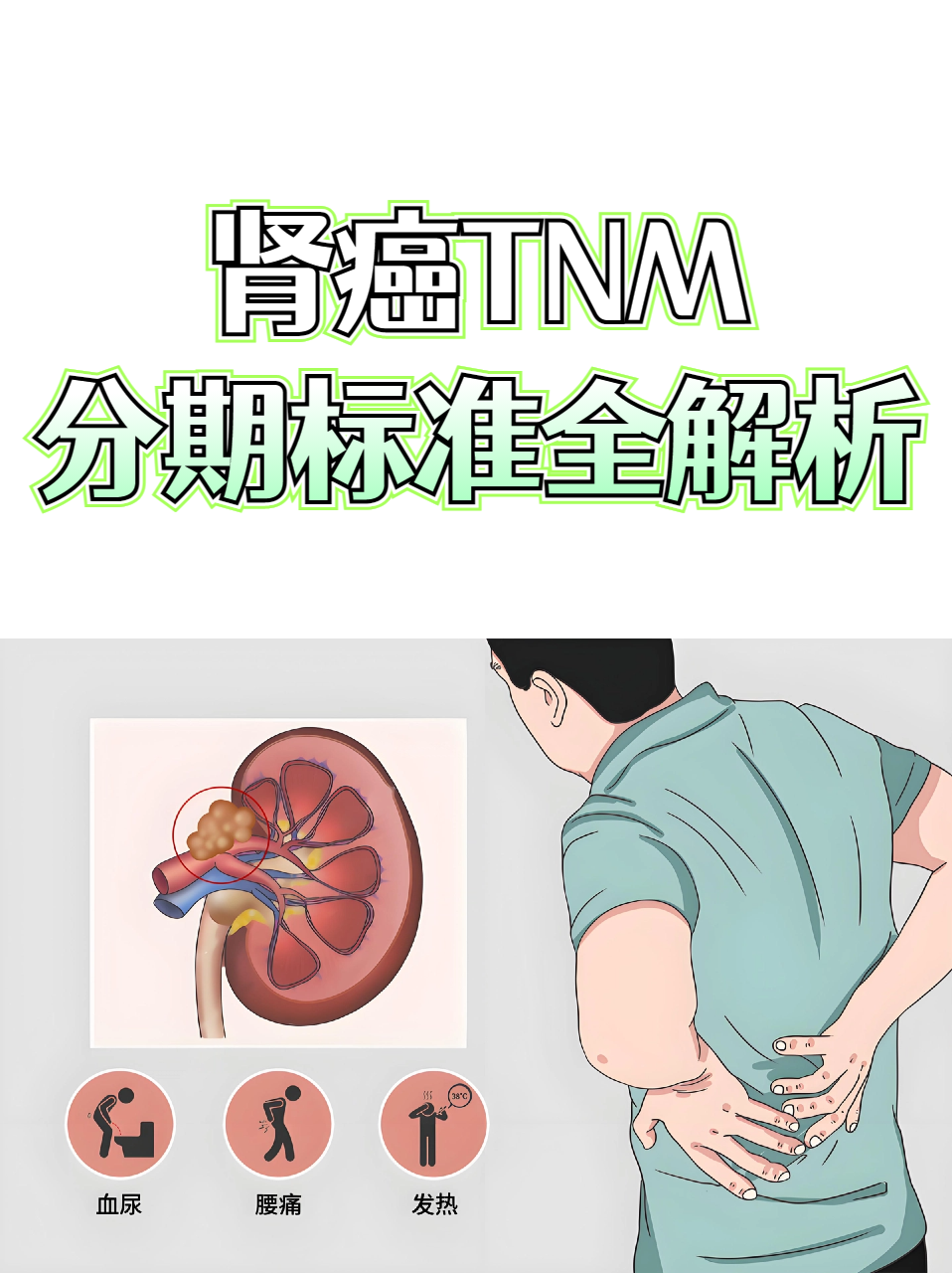 肾癌晚期症状都有什么?