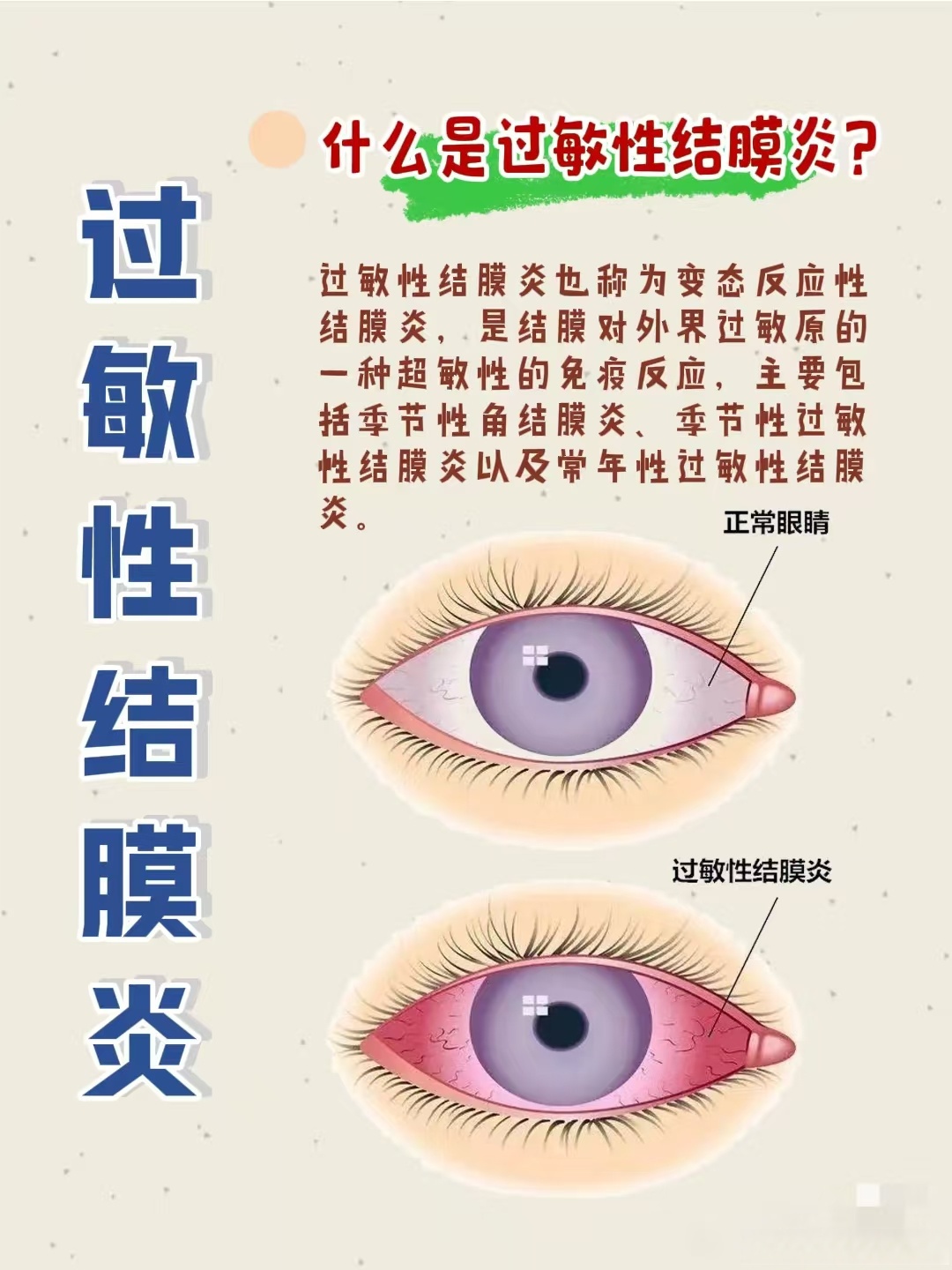 过敏性结膜炎怎么治疗