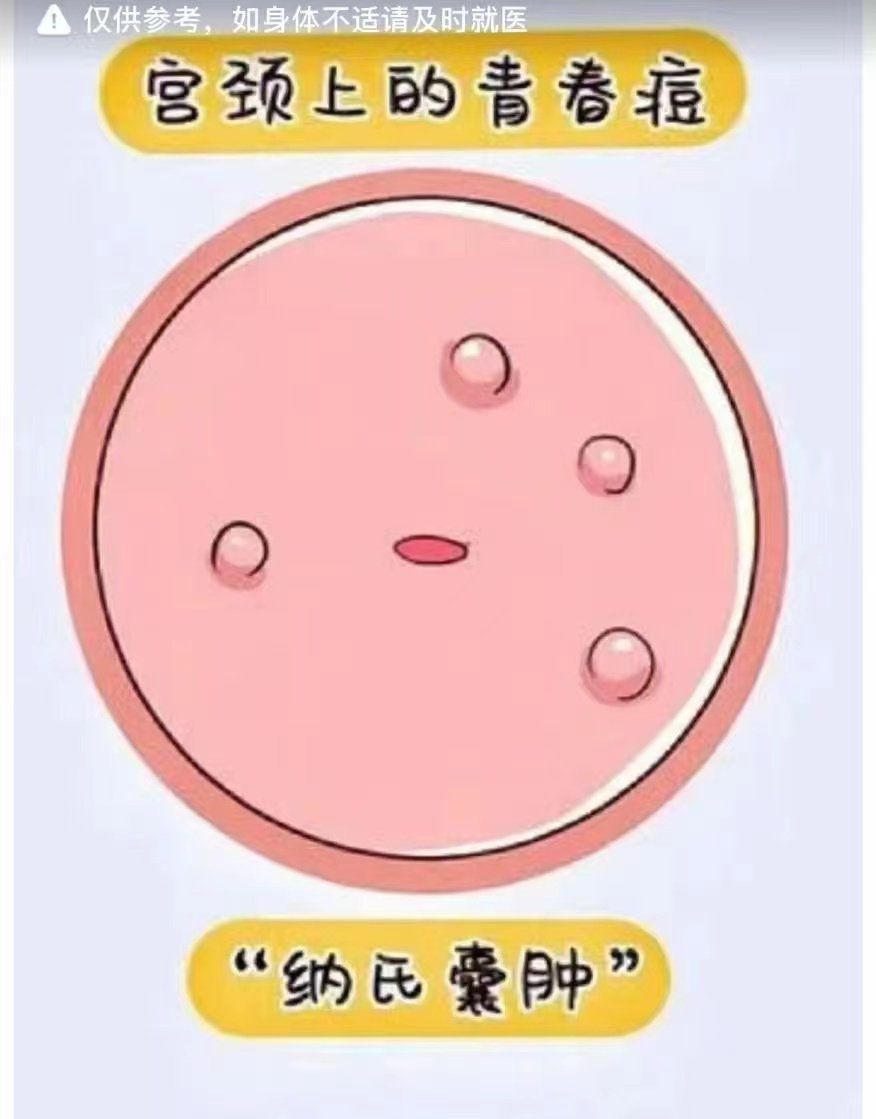 宫颈纳囊是什么意思?