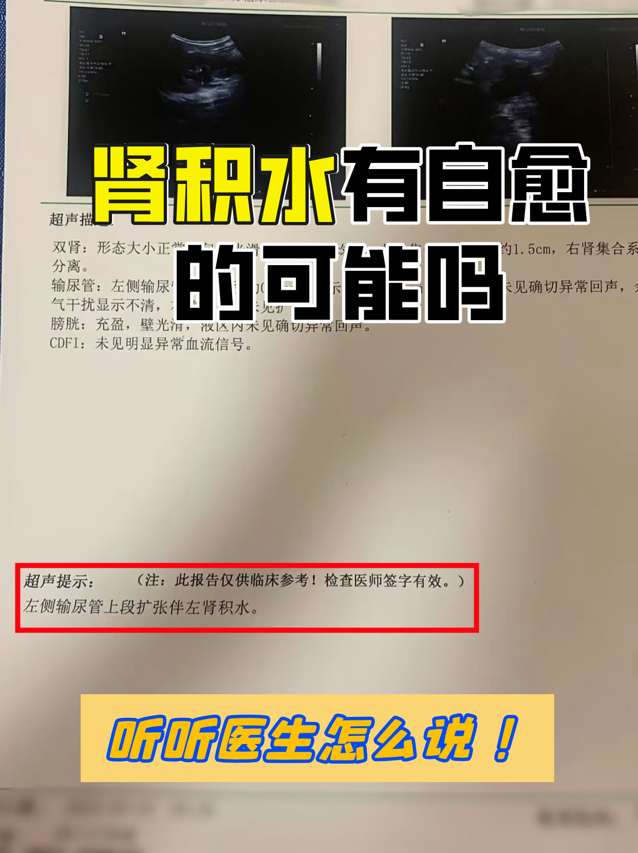 肾结石积水是怎么回事